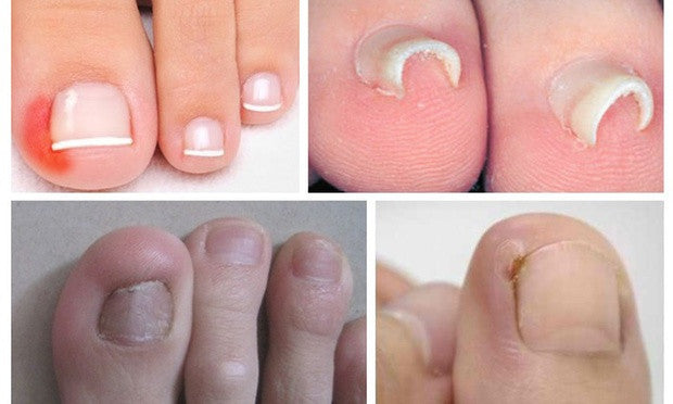 Ingrown Toe Nail Correction Tool