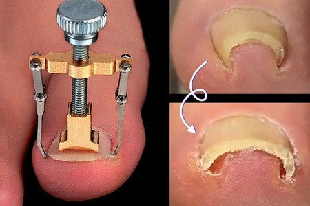 Ingrown Toe Nail Correction Tool