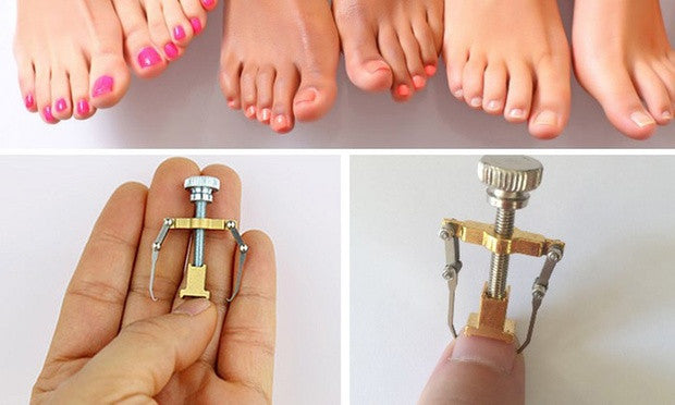 Ingrown Toe Nail Correction Tool