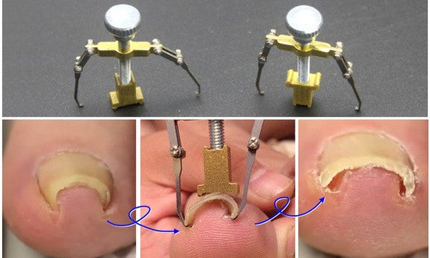 Ingrown Toe Nail Correction Tool