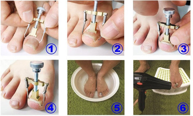 Ingrown Toe Nail Correction Tool