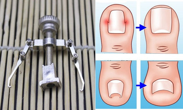 Ingrown Toe Nail Correction Tool
