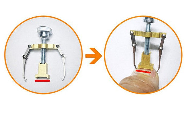 Ingrown Toe Nail Correction Tool